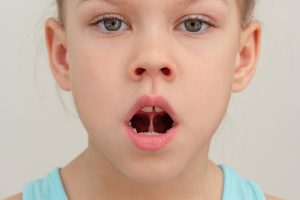 Sublingual Immunotherapy For Children With Respiratory Allergies